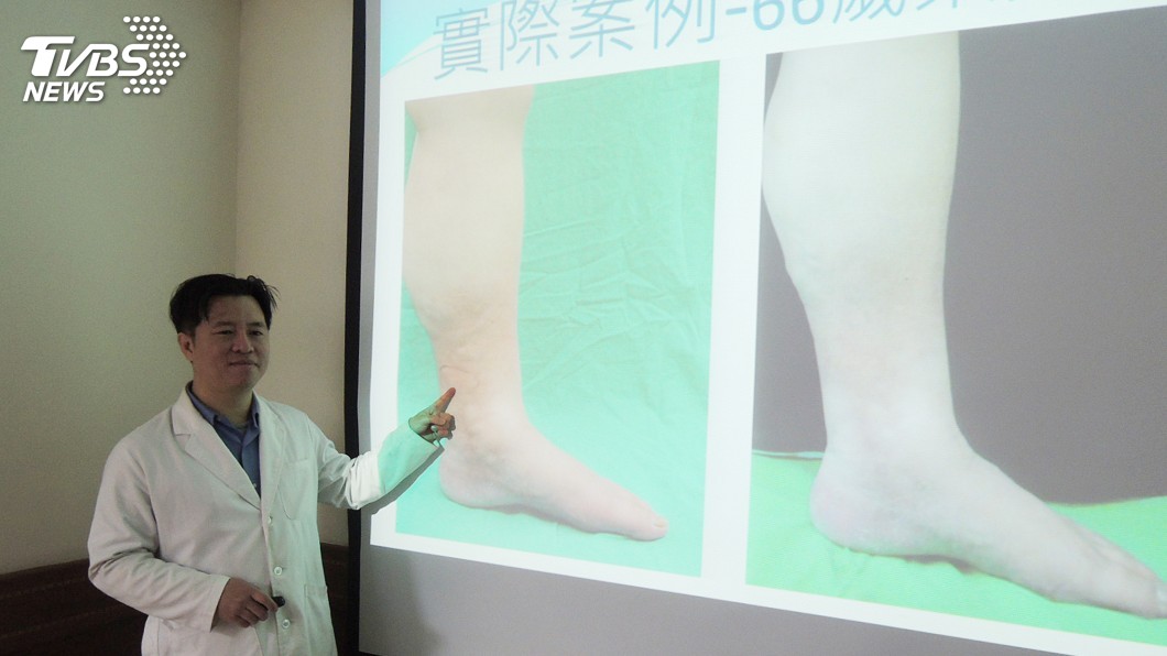 輕忽靜脈曲張　醫師：小心引發蜂窩性組織炎
