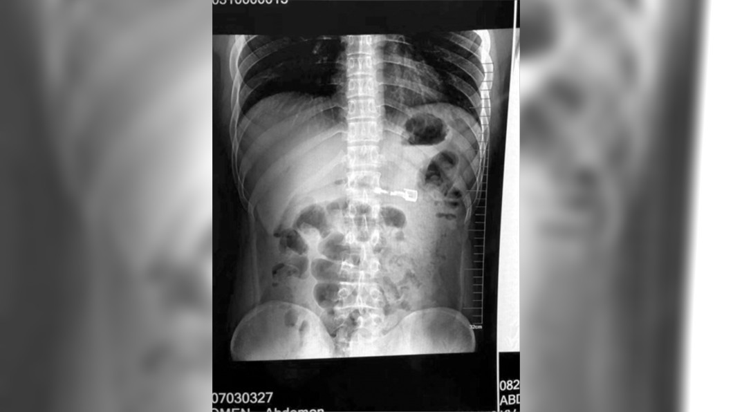 喝酒太嗨!男吞下8cm打火機 醫曝「恐怖風險」超駭人