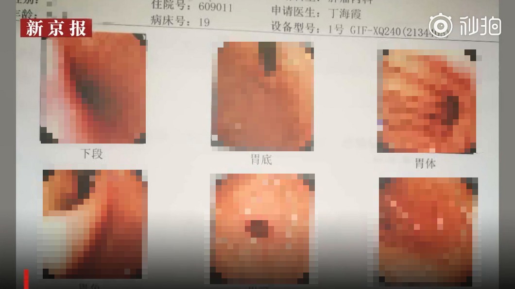聽信偏方「吞活蛆」治肺癌 醫照胃鏡嚇壞:滿肚肥蟲