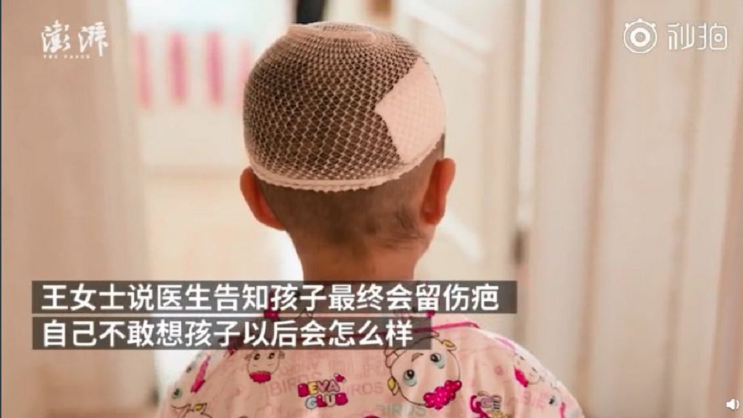 女童雖然保住一命，但未來恐面臨多次的整容手術。(圖／翻攝自微博)