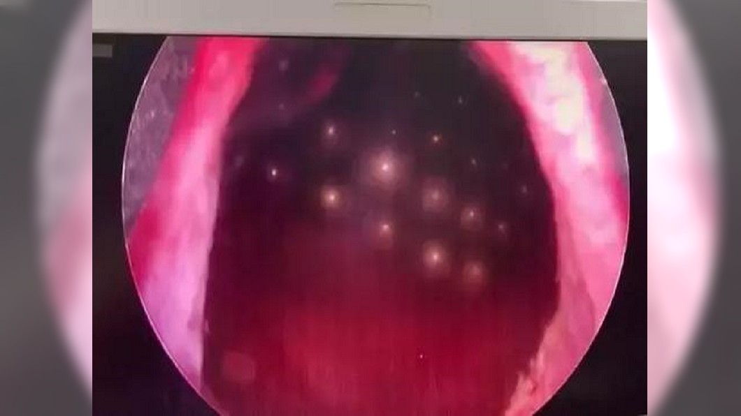 男童狂喊「小便好痛」 醫檢查大驚:下體塞70顆磁珠!