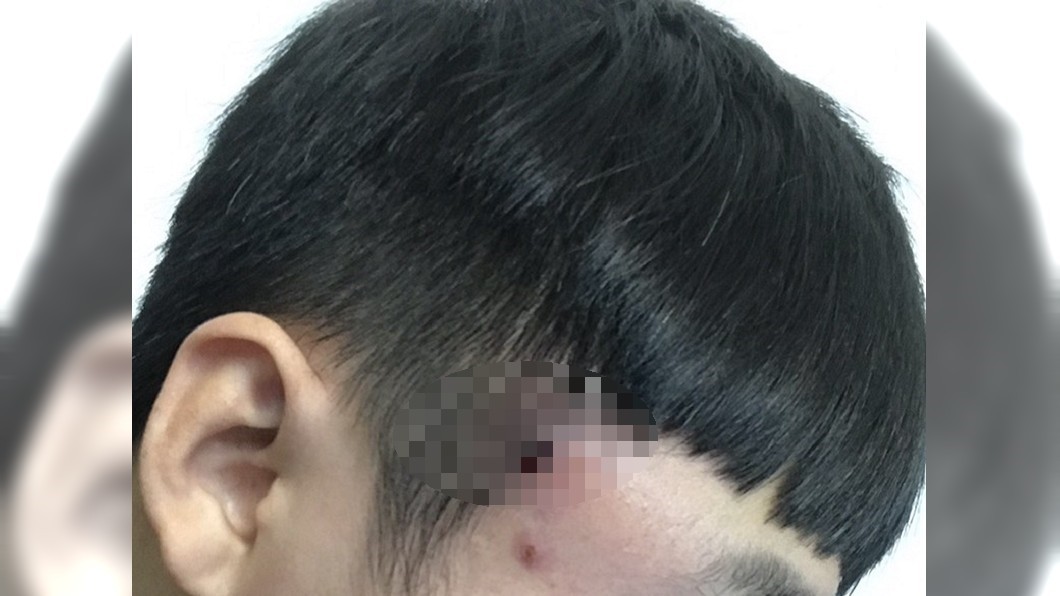 她PO「疔子全紀錄」　活像被子彈穿頭嚇壞人