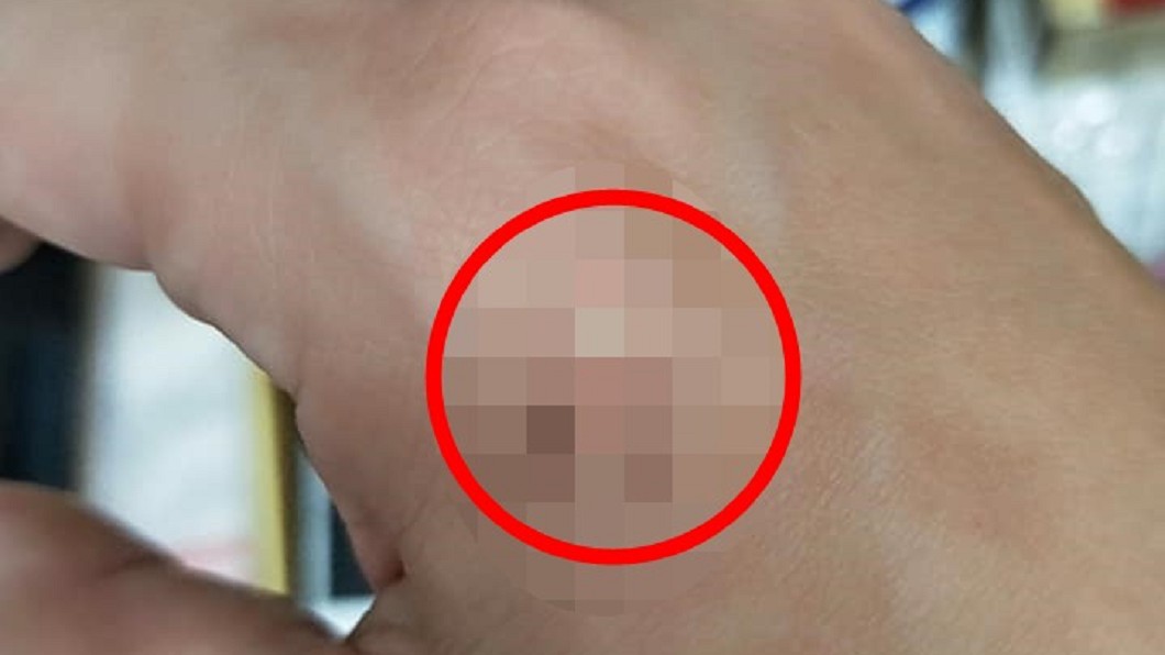 護理師被狠咬!烙下「深齒痕」痛爆 恐龍家長裝沒看見