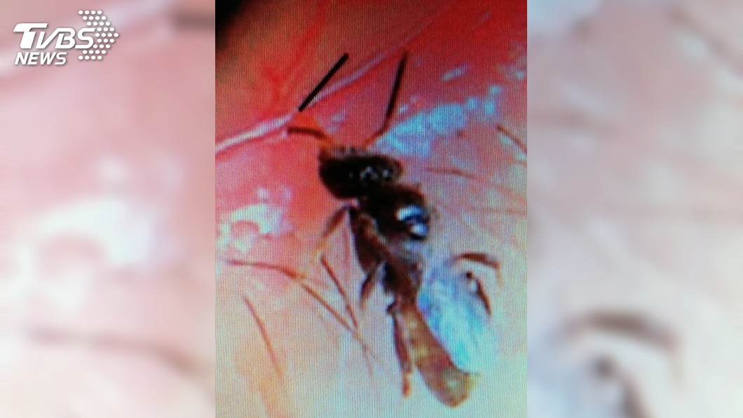 全球首例！女去掃墓後眼睛腫脹如鹹蛋　躲了4隻汗蜂