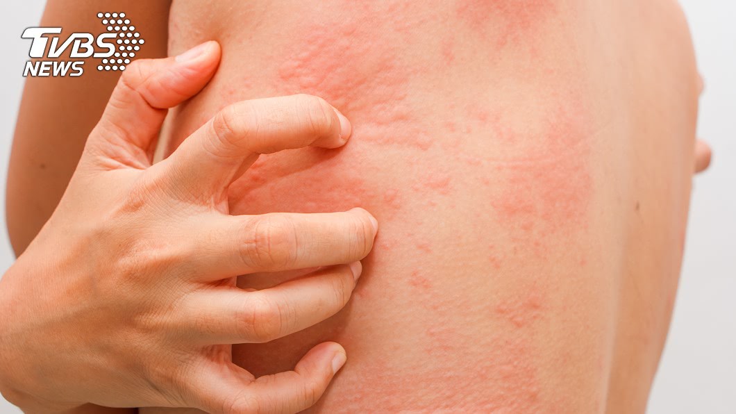 他「莫名全身癢」抓到手腳噴血 就醫發現竟是肝癌