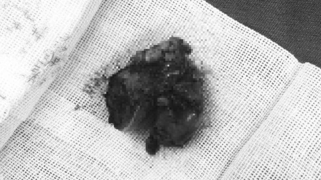 悚!男用力猛咳「扁桃腺」竟飛出 血肉團還連著喉嚨