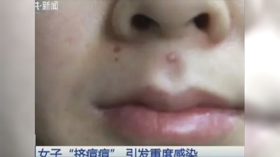 擠人中痘痘！她狂失禁險死　醫曝恐怖後果：這區別亂碰