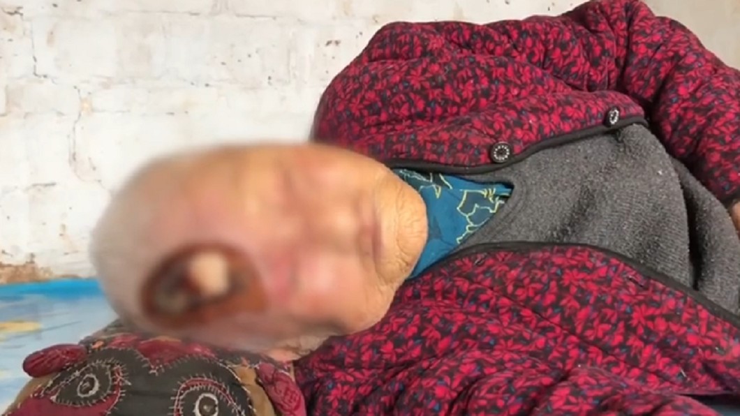 百歲婦撞傷頭!傷口潰爛「白骨外露」 兒竟拒送醫