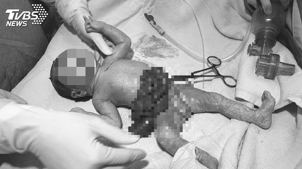 胎兒腹裂「臟器外露泡羊水」 醫全員搶救母淚謝