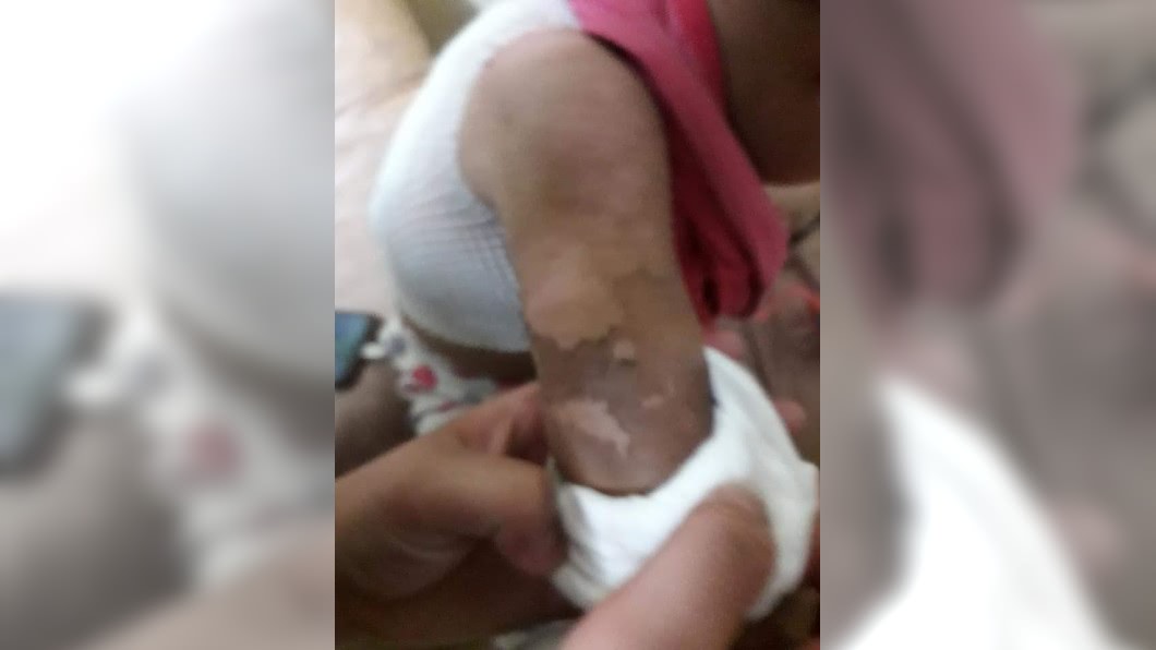 狠父丟洗衣機狂沖熱水3分鐘 2歲女童背部「整塊脫皮」