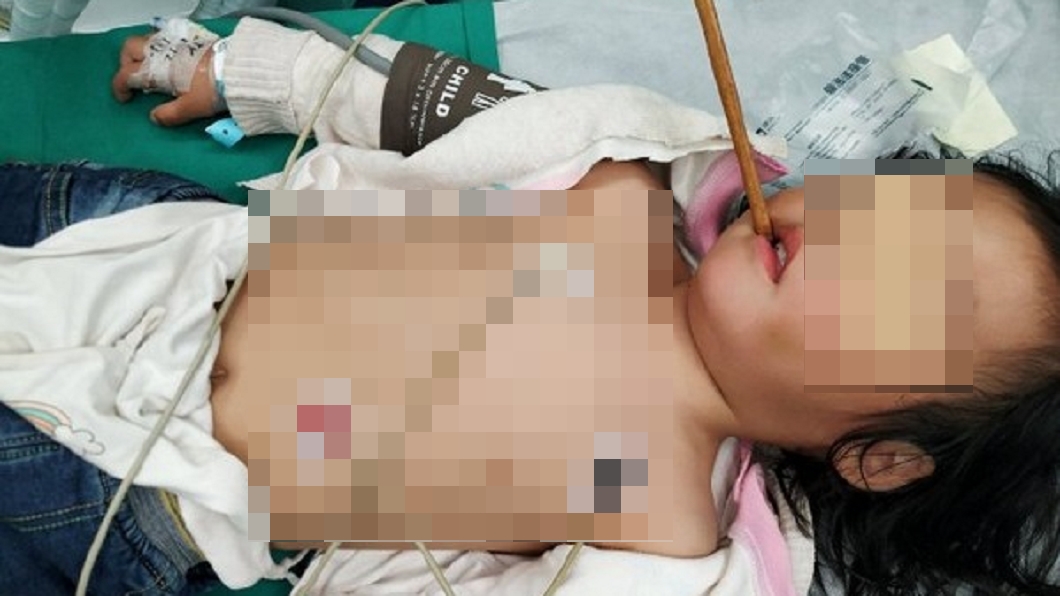 女童吃飯玩耍跌倒 筷子從口插入腦10公分