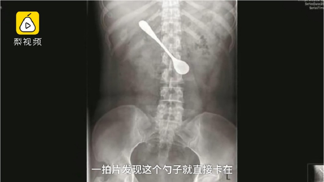魚刺卡喉嚨她狂挖 卻把13公分湯匙吞下肚