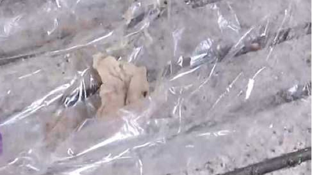 砸12萬隆鼻!她半年後打噴嚏 鼻飛棉球「發黑發臭」