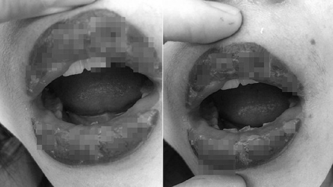 愛美去漂唇！輕熟女變香腸嘴　長滿水泡流膿