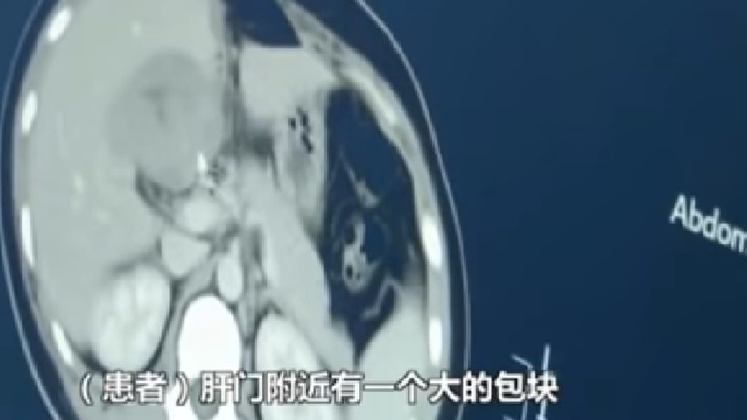 她懷孕子宮空的!CT一照「肝臟受精」 長出胚胎醫嚇傻
