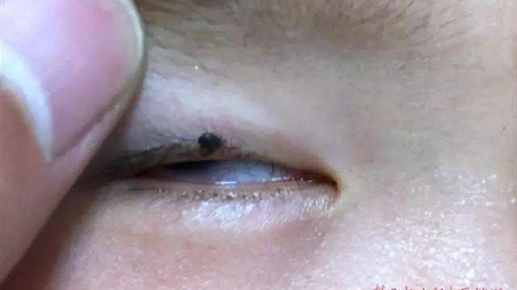 2歲童「眼皮多顆黑痣」隔天還變大 醫:差點斃命