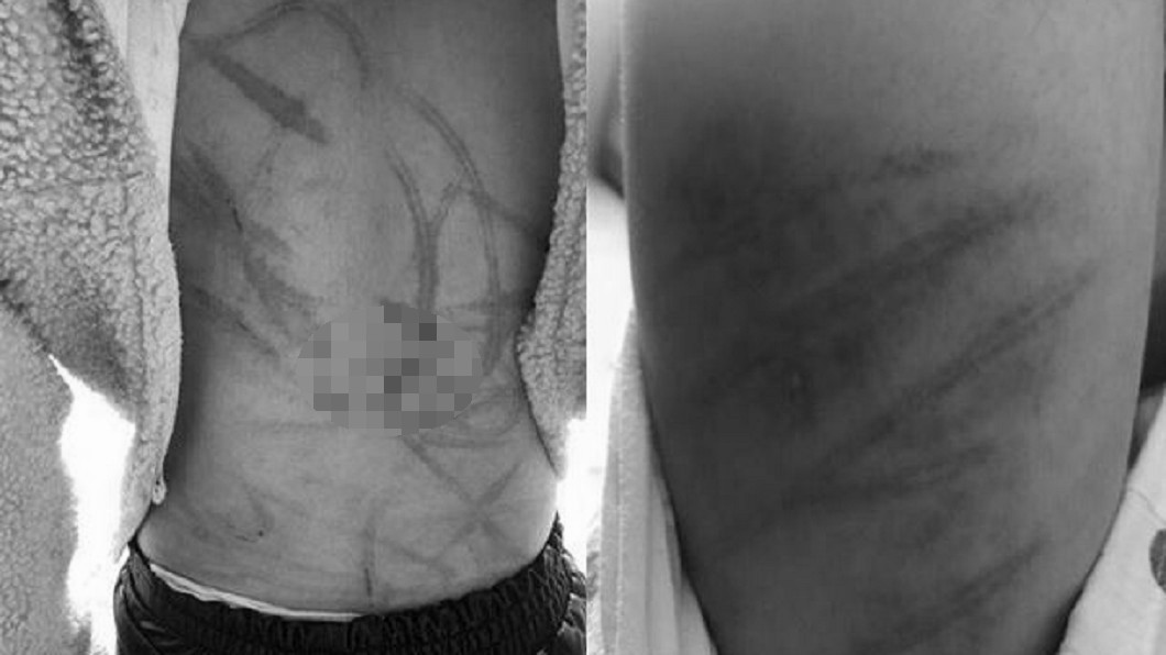 文具忘學校!10歲女遭暴打滿身「血痕」 狠父:家務事