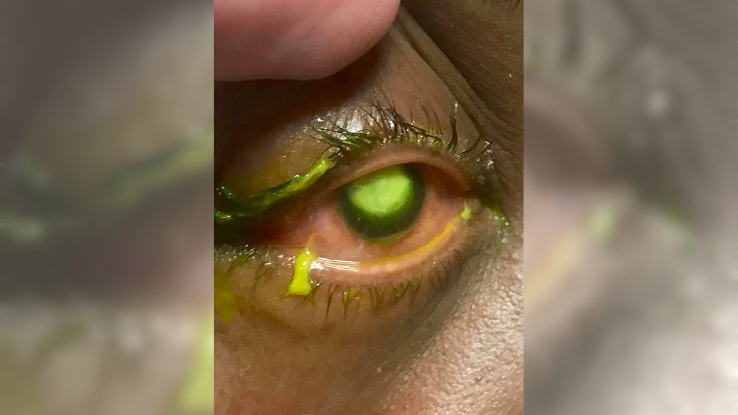 戴隱眼睡覺!她眼角膜遭細菌吞噬 狂冒膿液恐失明