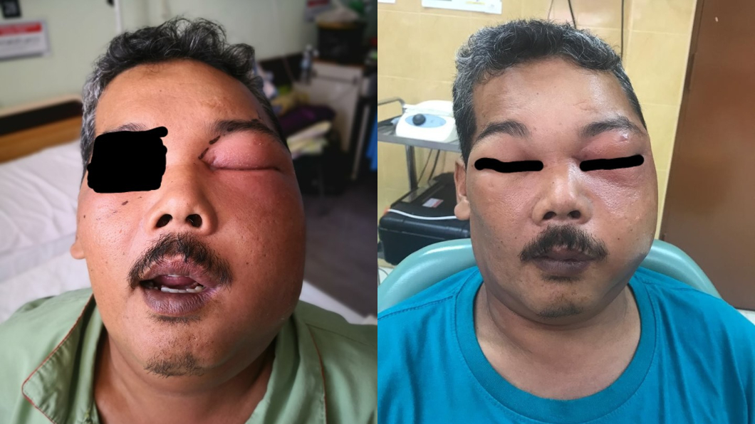 男牙疼信偏方「抹煞車油」 結果臉開洞流膿險喪命