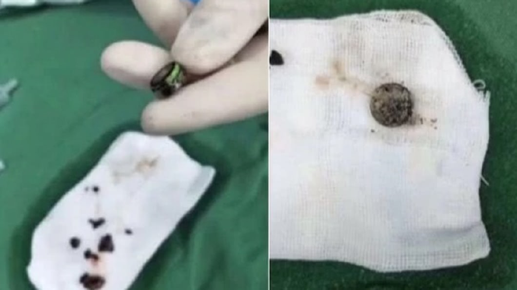 嚇壞!童臉部飄惡臭…送醫驚見「腐化電池」卡鼻腔