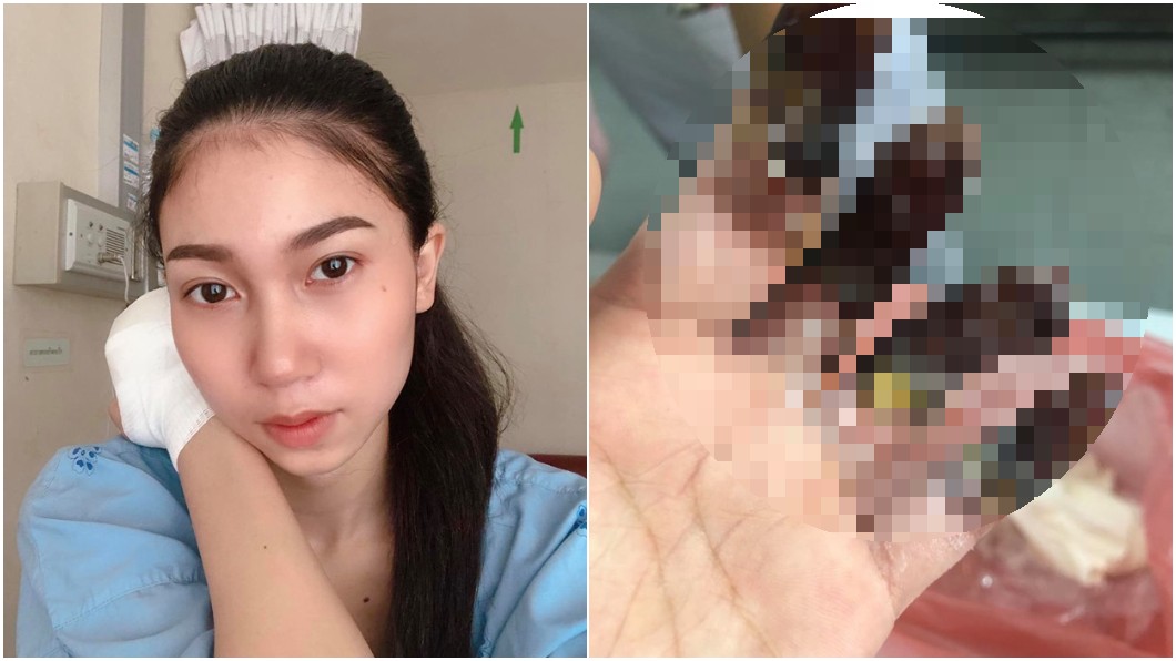 下個月就畢業!女大生實習燙傷慘截肢 淚崩:未來怎辦