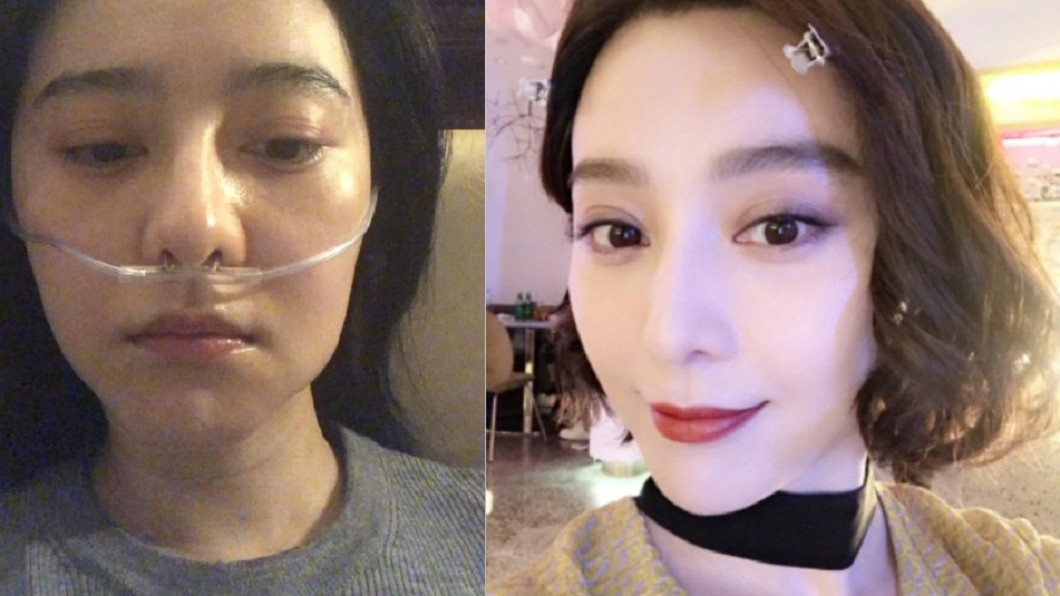 范冰冰做公益拚到病倒 臉腫吊點滴噴一地鼻血
