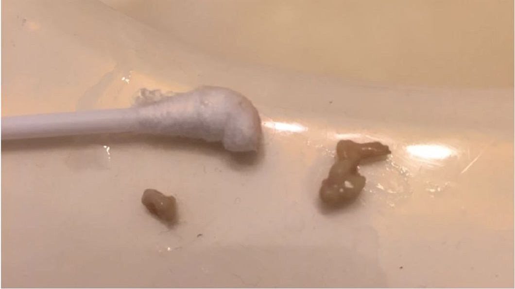 超療癒!他扁桃腺結石 用棉花棒猛戳秒噴「黃漿」