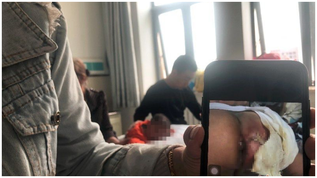悚!大太陽下玩溜滑梯 男童屁股「燙掉一層皮」