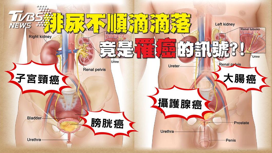 排尿不順?小心是腫瘤在作怪!