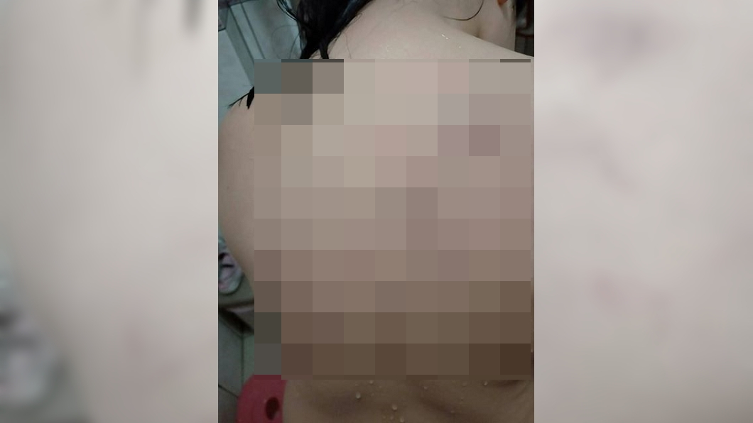 新北幼兒園又爆不當體罰 女童遭打背部全瘀青