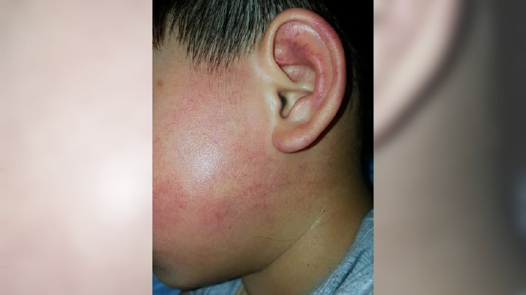 3歲童疑遭掌摑「下體被抓傷」 幼兒園僅回:不知道