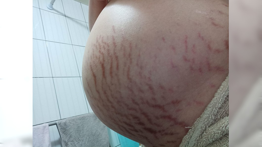 肚皮布滿密麻「紅色小蟲」　她淚貼0修圖照…網直呼偉大