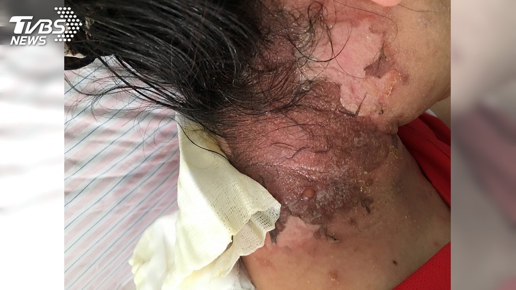 肩頸痛敷草藥5分鐘　婦人後頸發黑潰爛痛如火燒