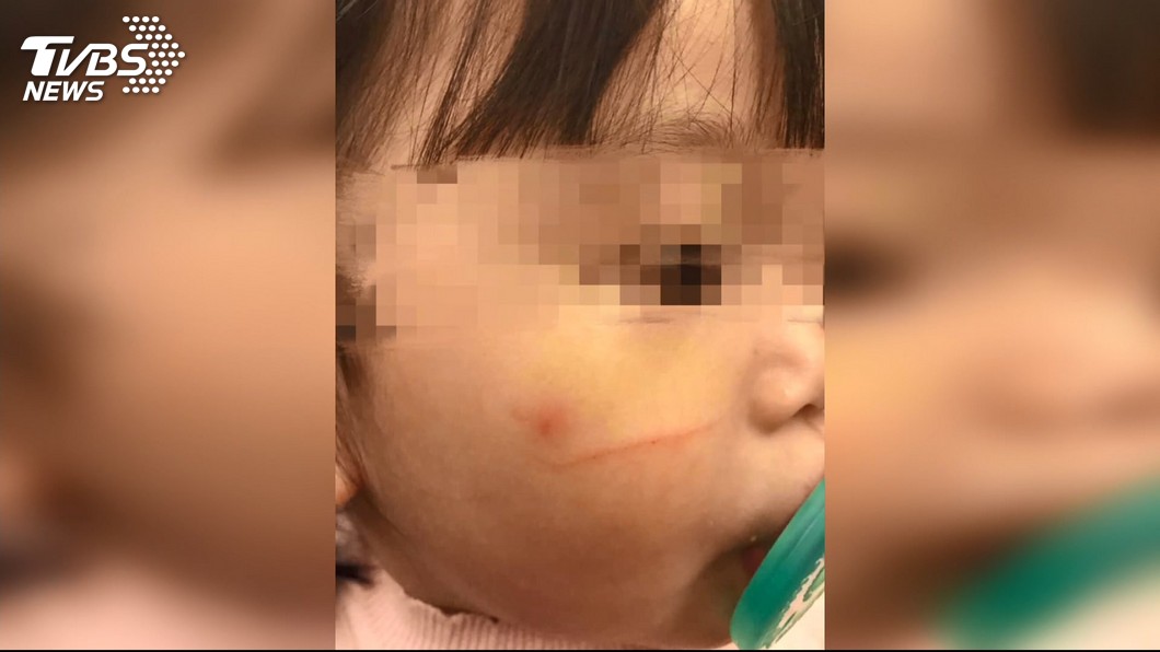 托嬰中心虐童？　2歲女童臉上竟有巴掌印