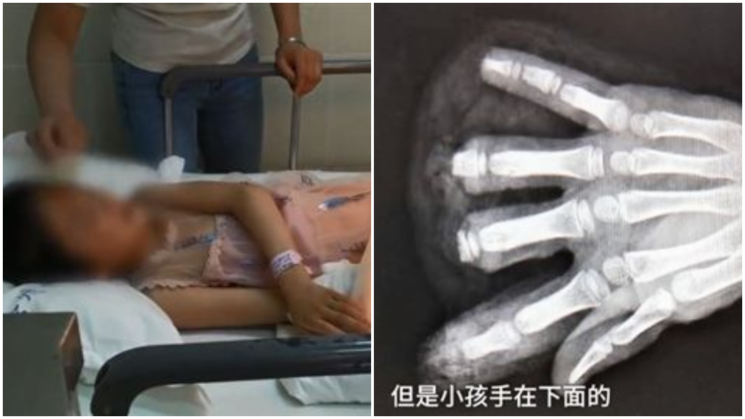 8歲女童玩耍遭機器夾手 4根指頭全斷了