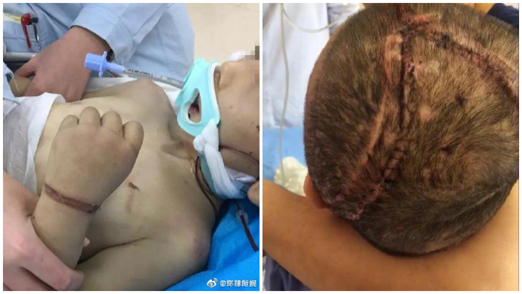 繼母狠虐！6歲童顱骨粉碎、全身爛成植物人…生父不聞問