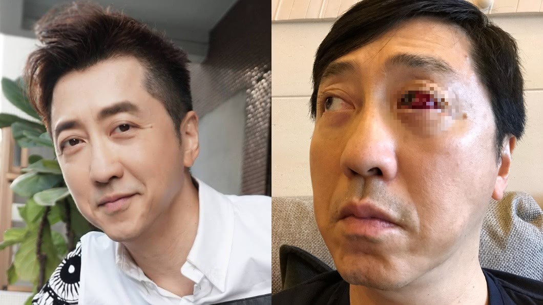 嚇！庾澄慶曝眼球爆血照　「眼白全消失」嚇壞粉絲