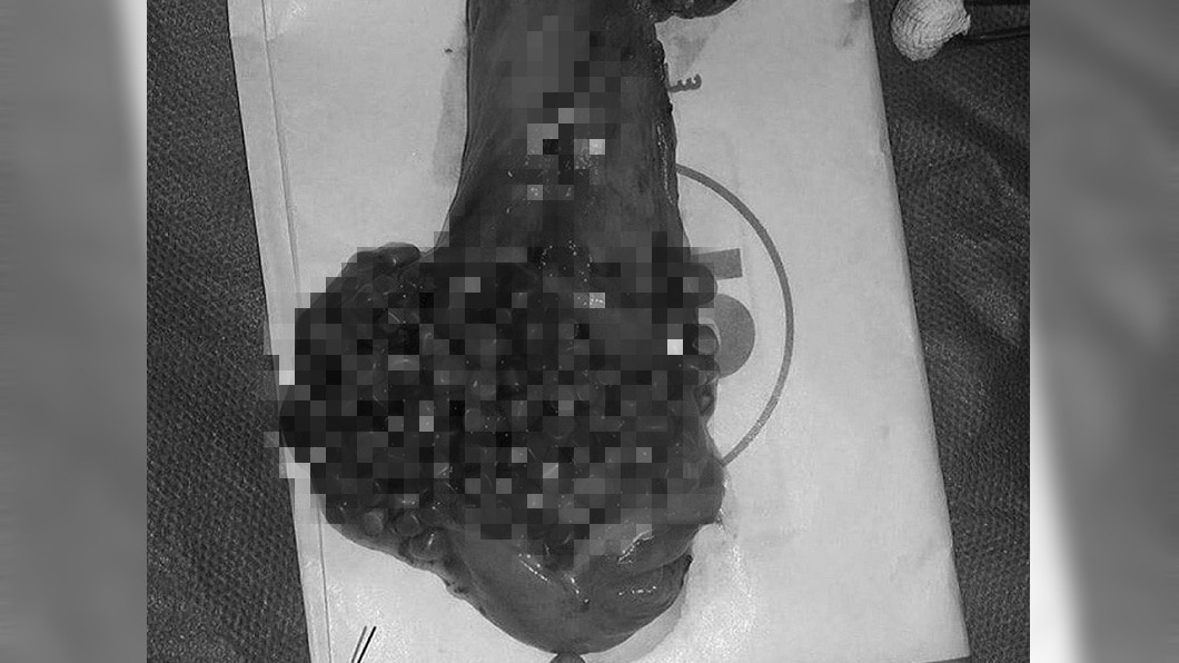 醫剖開膽囊…驚見百顆密麻結石 網嚇傻:感覺好痛