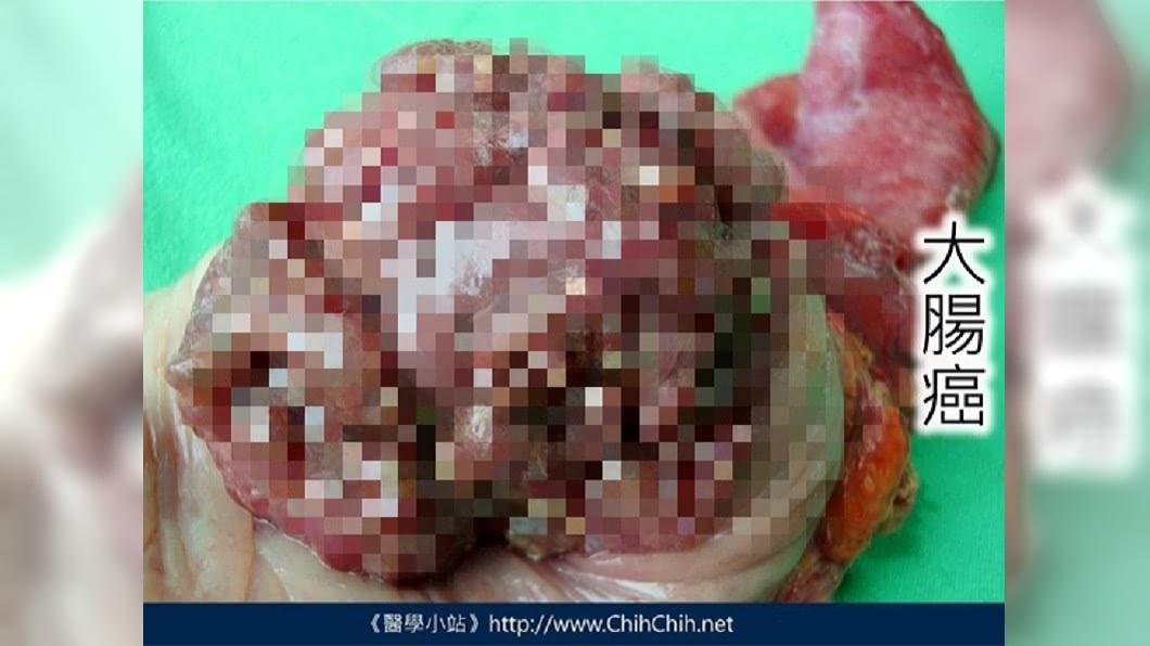 多圖慎入!「大腸癌」長什麼樣 醫公布恐怖實況照