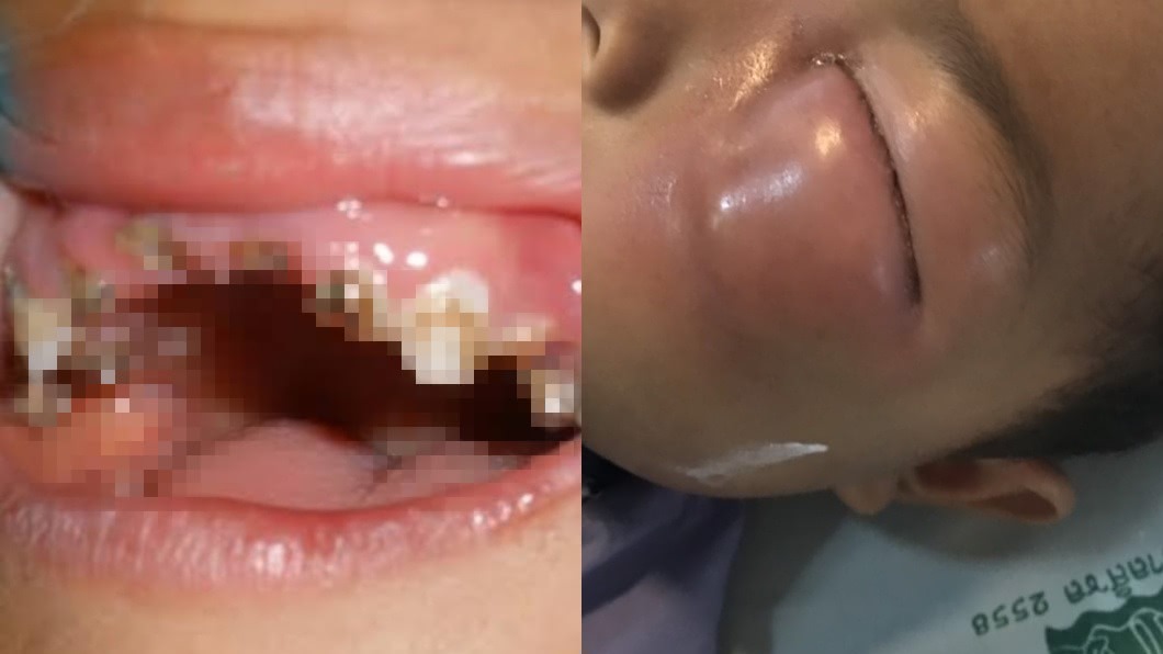 超愛吃糖!3歲童牙齒全爛光 「牙菌還擴散」險失明