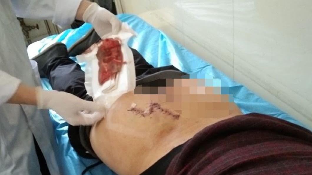 男子的臀部縫了數十針,但旅館卻稱說是他操作不當所導致。(圖/翻攝自陸網)