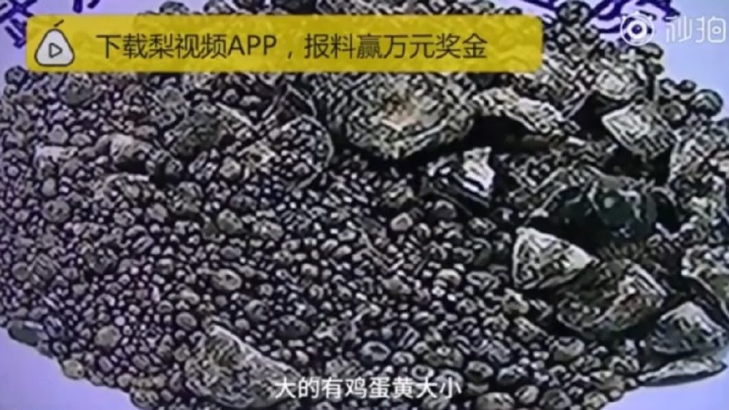 大媽不吃早餐不愛喝水 醫挖出7750顆結石塞爆膽囊