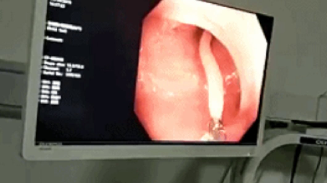 肚痛十幾年找嘸病因　照腸鏡驚見「30公分蛔蟲」狂蠕動