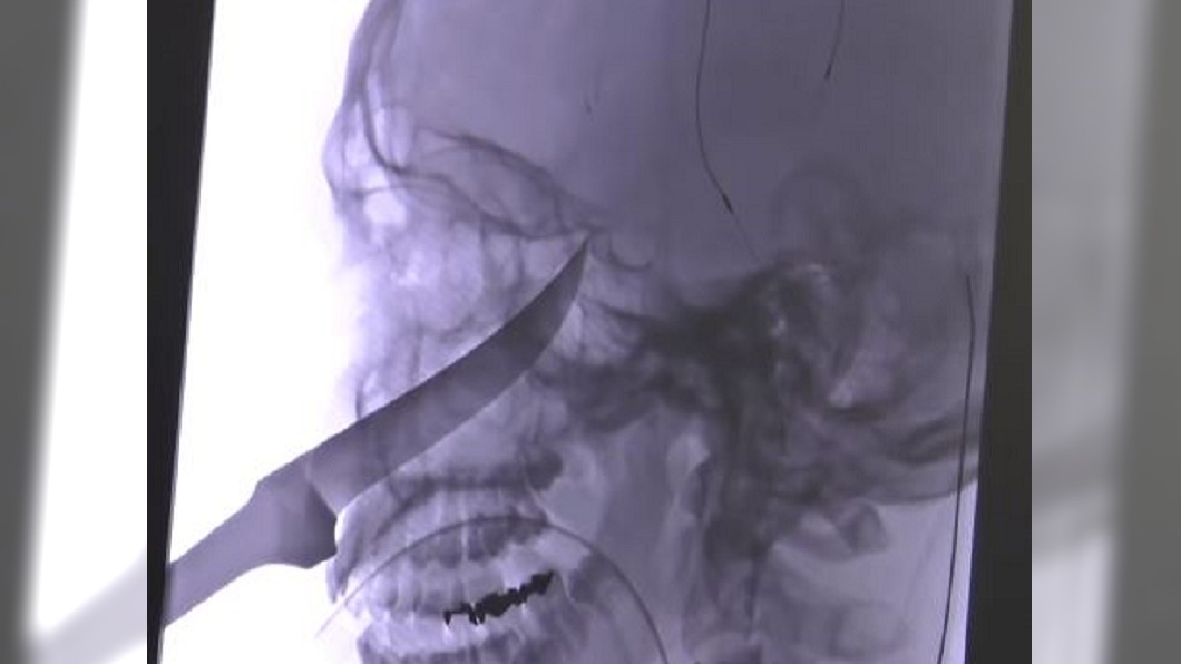 長刀插臉險刺穿頸動脈　美國15歲少年奇蹟逃死