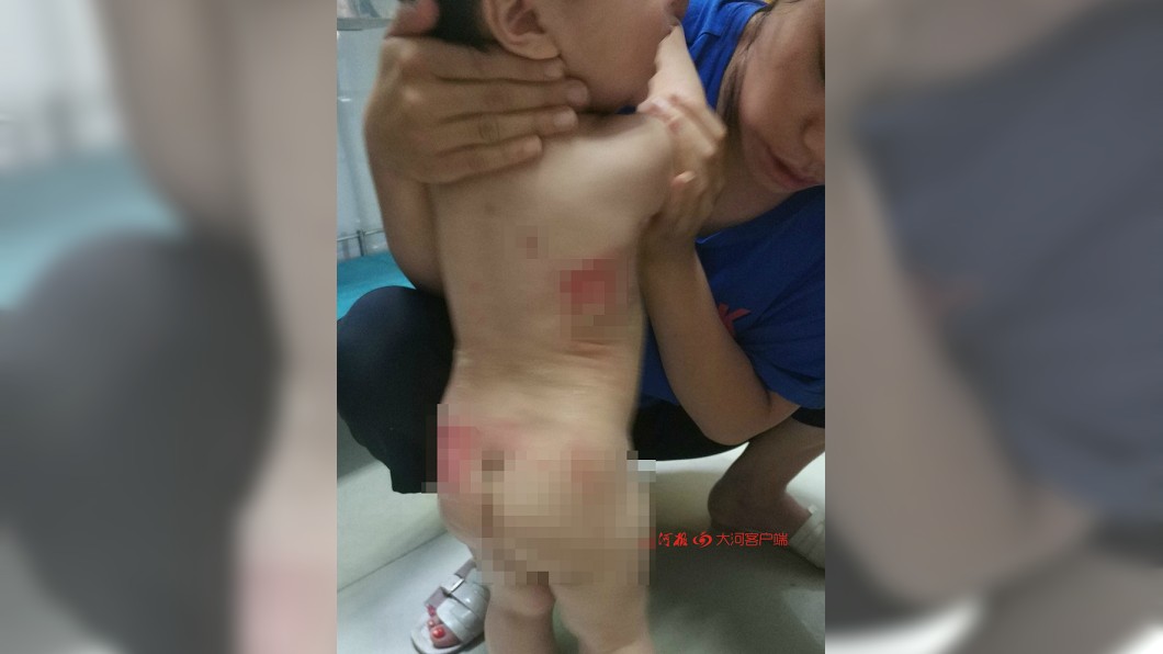女嬰被熱湯燙到後,後背及臀部出現紅腫傷痕。圖/翻攝自微博