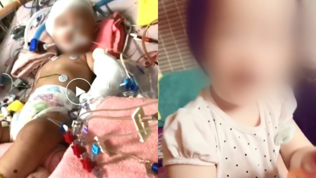 台中受虐女嬰情況好轉　昏迷指數上升到6「可自主呼吸」