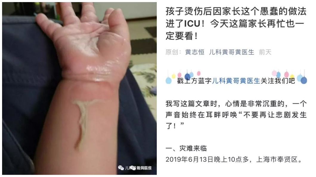 天兵父信偏方 4歲兒被燙傷淋白酒害中毒送加護病房