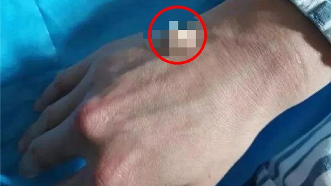 5男耍帥學「筷子開瓶」!用力一拍插進掌心 手背冒山丘