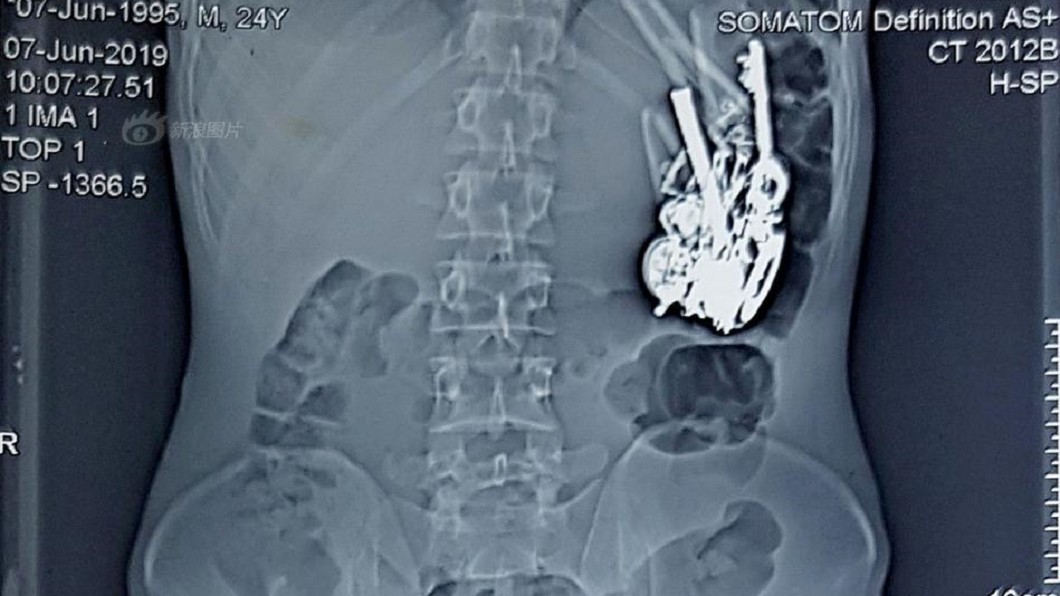 男腹痛動手術 刀片等金屬異物塞爆胃驚呆醫生