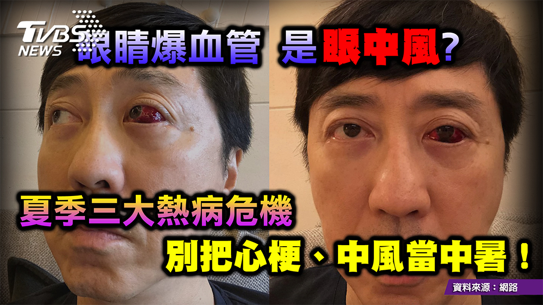 「中風」「中暑」分不清 掌握關鍵 避免錯過黃金搶救期